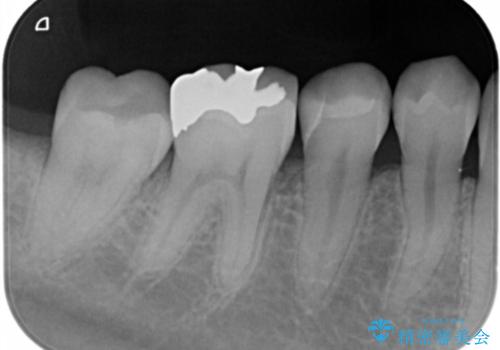 銀の詰め物を白くしたい。の治療後
