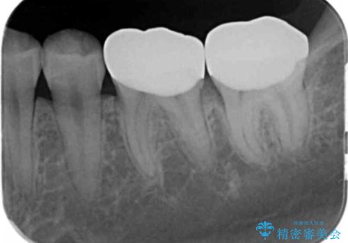 変色した樹脂の詰め物 セラミックでのやり替えの治療後