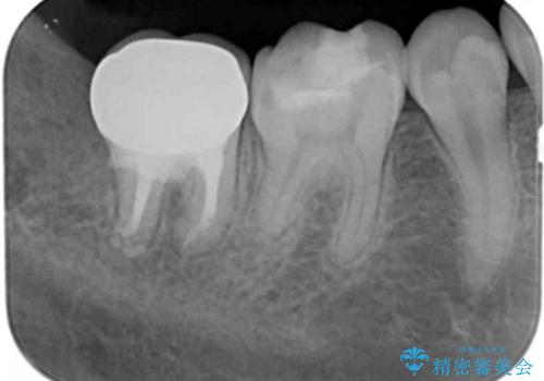 [ 精密根管治療 ]  他院で抜歯しかないと言われた歯を残すの治療後