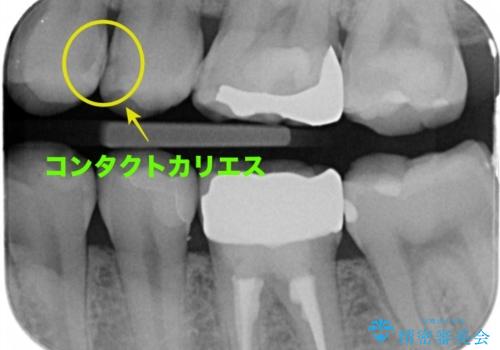 コンタクトカリエスの治療