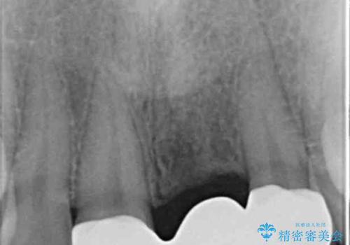 前歯のブリッジ治療