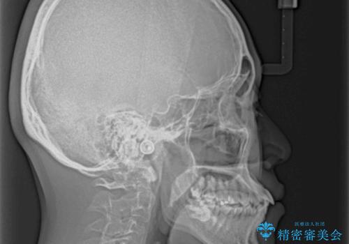 少しでも口元を閉じやすく インビザラインによる前突の解消の治療前