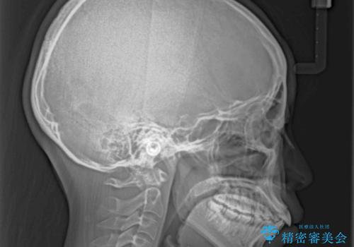 【モニター】短期間で口の閉じにくさを改善 ワイヤー装置での抜歯矯正の治療前