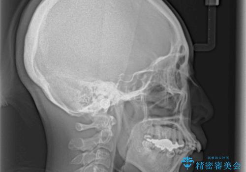 内側に倒れた前歯と口元の突出感 ワイヤー装置での抜歯矯正の治療前