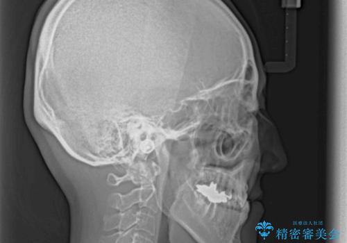 急速拡大装置 前歯の反対咬合をインビザラインで改善の治療前
