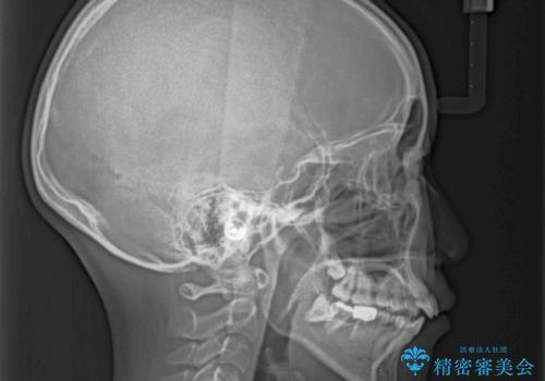 目立たない裏側矯正で突出感を改善 ハーフリンガル矯正の治療前