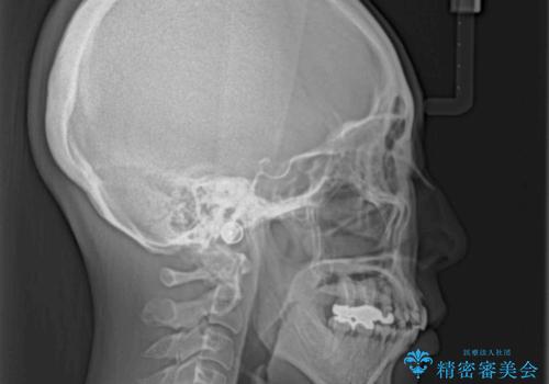 内側に倒れた前歯と口元の突出感 ワイヤー装置での抜歯矯正の治療後