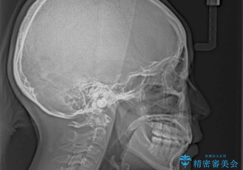 【モニター】短期間で口の閉じにくさを改善 ワイヤー装置での抜歯矯正の治療後