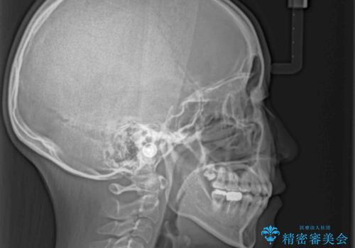 目立たない裏側矯正で突出感を改善 ハーフリンガル矯正の治療後