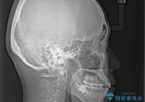 少しでも口元を閉じやすく インビザラインによる前突の解消の治療後