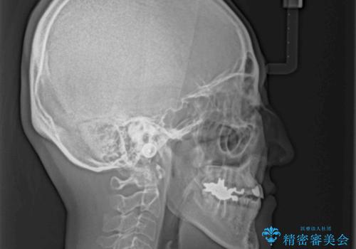 急速拡大装置 前歯の反対咬合をインビザラインで改善の治療後