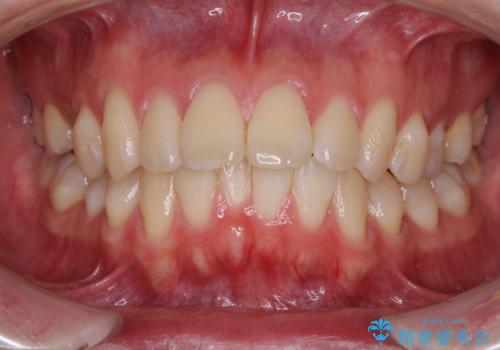 少しでも口元を閉じやすく インビザラインによる前突の解消の症例 治療前