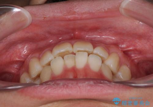 少しでも口元を閉じやすく インビザラインによる前突の解消の治療前