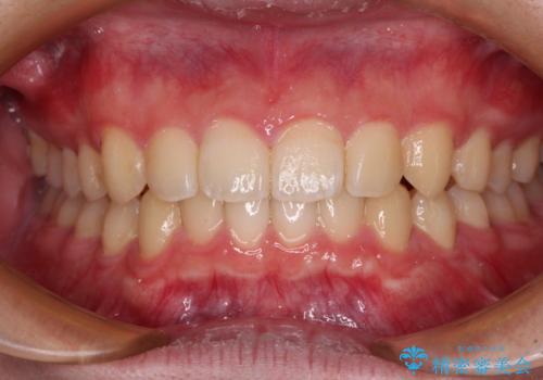 【モニター】斜めに突き出した前歯をインビザラインで改善の症例 治療後