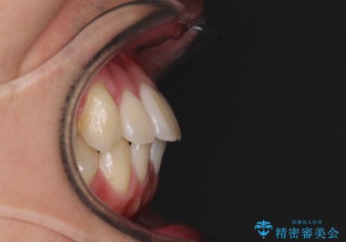 少しでも口元を閉じやすく インビザラインによる前突の解消の治療前