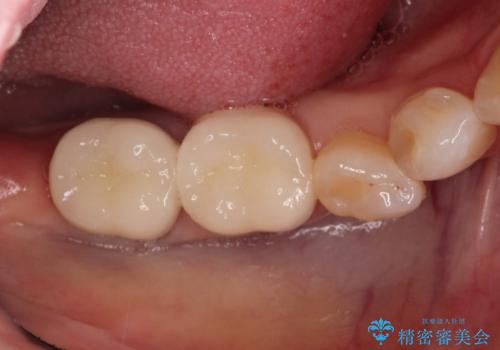 【オールセラミッククラウン】他院で治療した被せものが外れたの症例 治療後