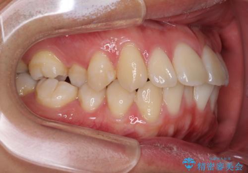少しでも口元を閉じやすく インビザラインによる前突の解消の治療前