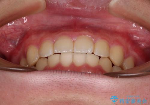 【モニター】斜めに突き出した前歯をインビザラインで改善の治療後