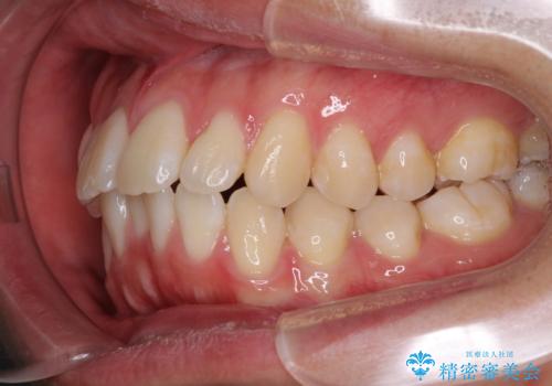 少しでも口元を閉じやすく インビザラインによる前突の解消の治療前