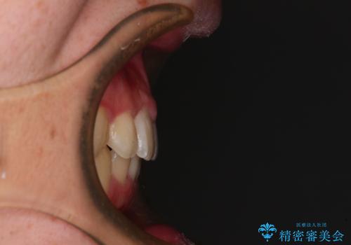 【モニター】斜めに突き出した前歯をインビザラインで改善の治療後