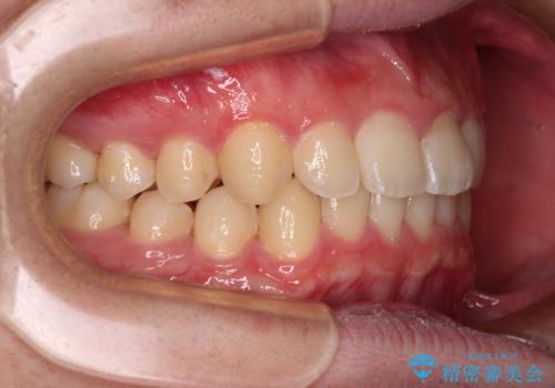 【モニター】斜めに突き出した前歯をインビザラインで改善の治療後