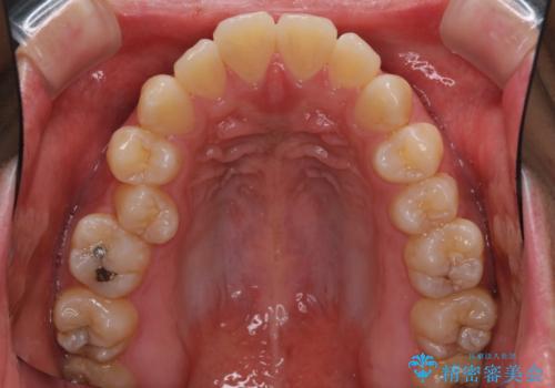 少しでも口元を閉じやすく インビザラインによる前突の解消の治療前