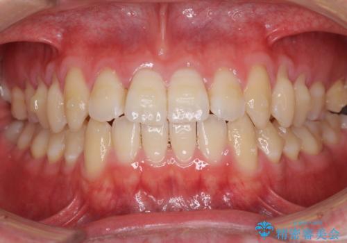 軽微なデコボコを安価に インビザライン・ライトによる矯正治療の治療中