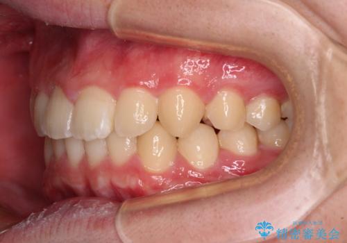 【モニター】斜めに突き出した前歯をインビザラインで改善の治療後