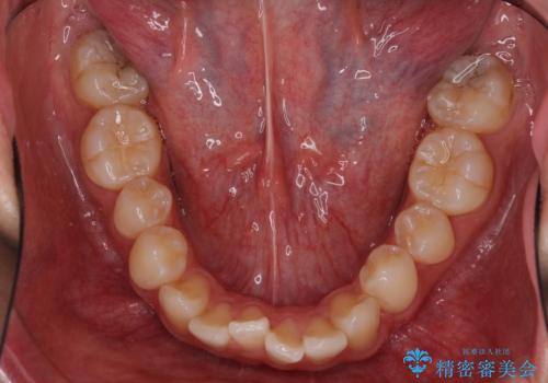 少しでも口元を閉じやすく インビザラインによる前突の解消の治療前