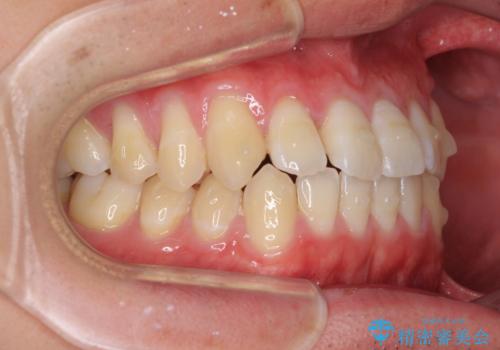 軽微なデコボコを安価に インビザライン・ライトによる矯正治療の治療中