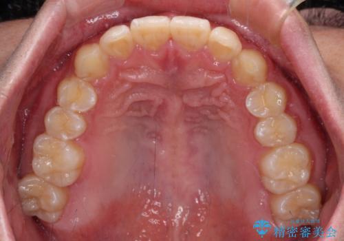 【モニター】斜めに突き出した前歯をインビザラインで改善の治療後