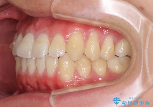 軽微なデコボコを安価に インビザライン・ライトによる矯正治療の治療中