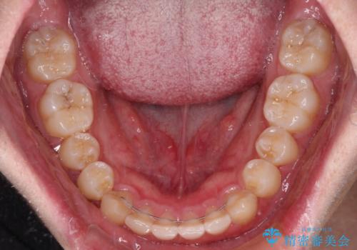 【モニター】斜めに突き出した前歯をインビザラインで改善の治療後