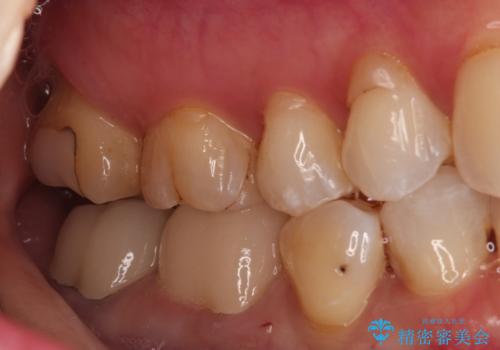 【オールセラミッククラウン】他院で治療した被せものが外れたの治療後