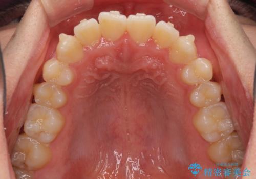 軽微なデコボコを安価に インビザライン・ライトによる矯正治療の治療中