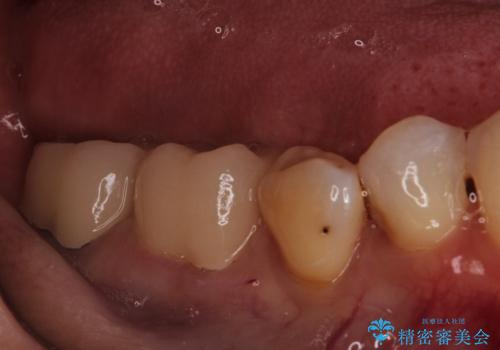 【オールセラミッククラウン】他院で治療した被せものが外れたの治療後