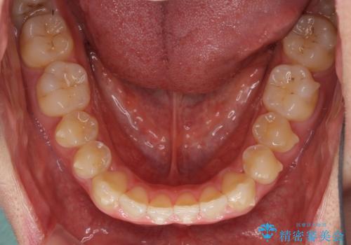 軽微なデコボコを安価に インビザライン・ライトによる矯正治療の治療中