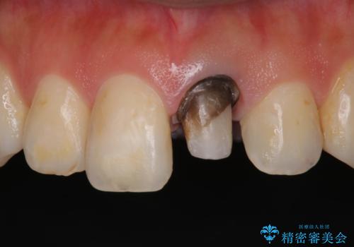 矯正治療が終了し、前歯を治したいの治療中