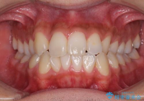 【モニター】左右のクロスバイトをインビザラインできれいに改善の症例 治療前