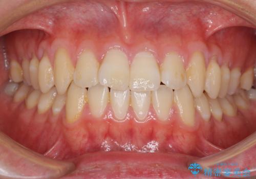 軽微なデコボコを安価に インビザライン・ライトによる矯正治療の治療前