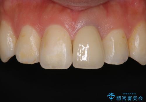 矯正治療が終了し、前歯を治したいの症例 治療後