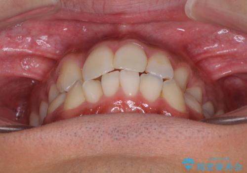 【モニター】左右のクロスバイトをインビザラインできれいに改善の治療前