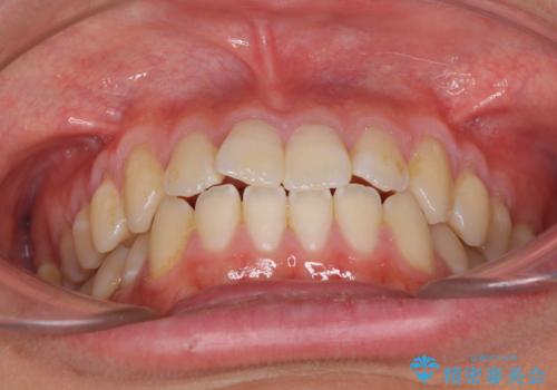 軽微なデコボコを安価に インビザライン・ライトによる矯正治療の治療前