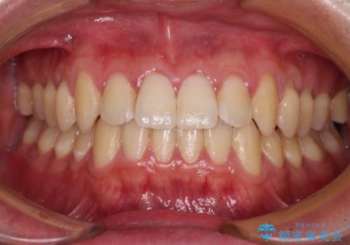 軽微なデコボコを安価に インビザライン・ライトによる矯正治療の治療後