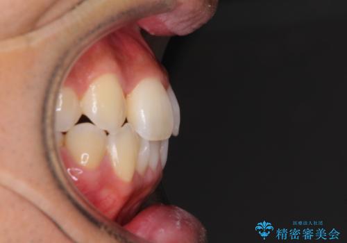 【モニター】左右のクロスバイトをインビザラインできれいに改善の治療前