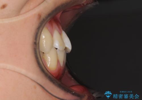 軽微なデコボコを安価に インビザライン・ライトによる矯正治療の治療前