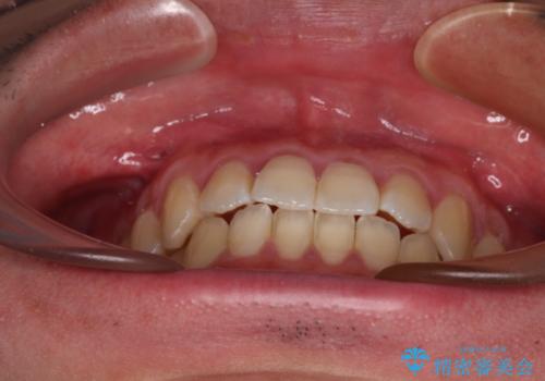 軽微なデコボコを安価に インビザライン・ライトによる矯正治療の治療後