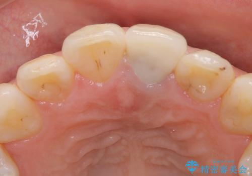矯正治療が終了し、前歯を治したいの治療後