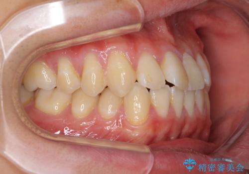 軽微なデコボコを安価に インビザライン・ライトによる矯正治療の治療前