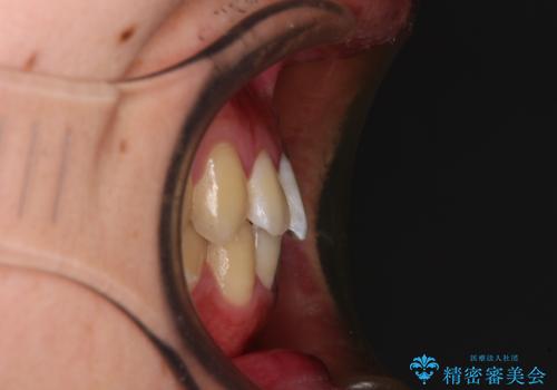 軽微なデコボコを安価に インビザライン・ライトによる矯正治療の治療後